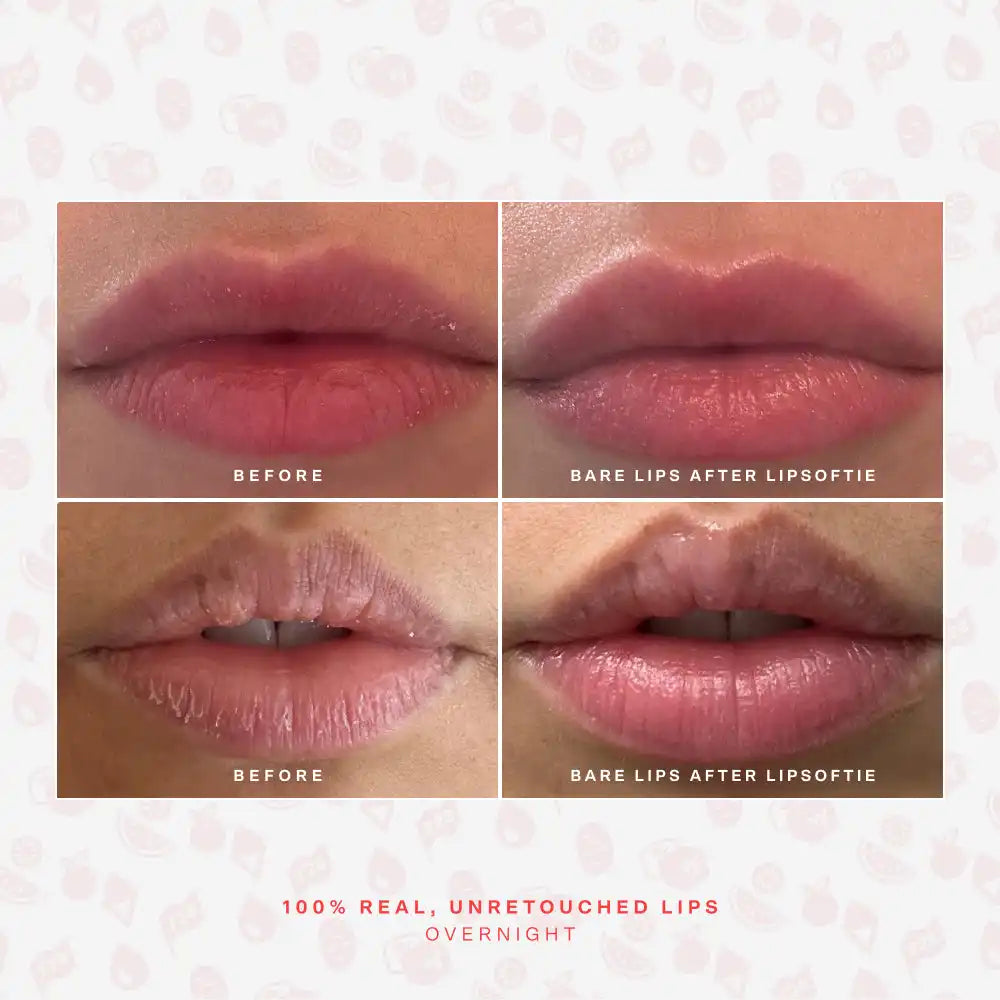 LipSoftie® Lip Treatment