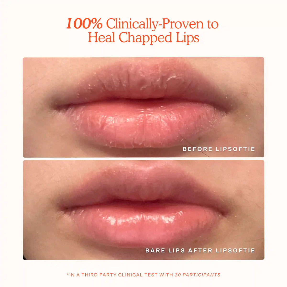 LipSoftie® Lip Treatment