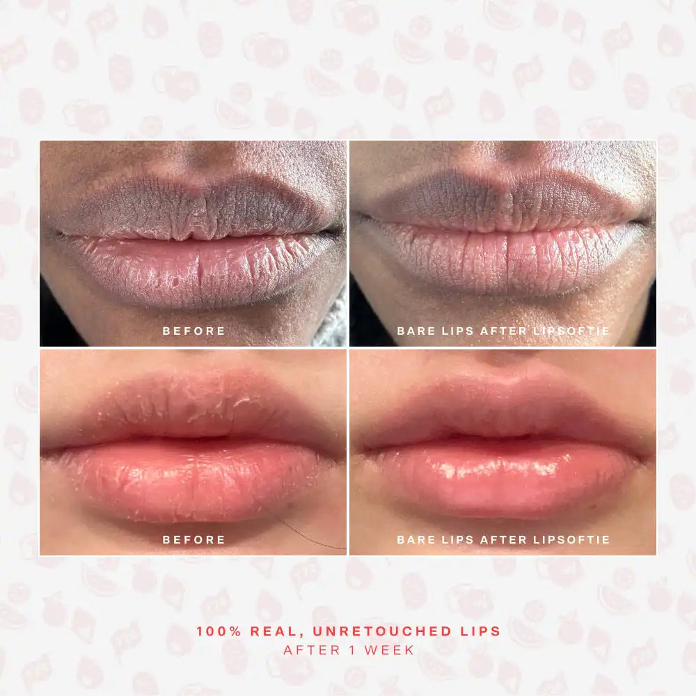 LipSoftie® Lip Treatment Set